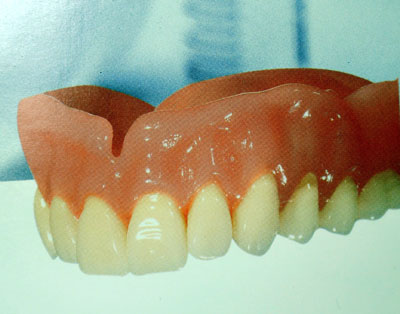 Съемный пластиночный протез показания. Пластинчатые зубные импланты. Матрица круглая в пластиночный протез. Полный съемный пластиночный протез фото. Протяженные дефекты стоматологии.
