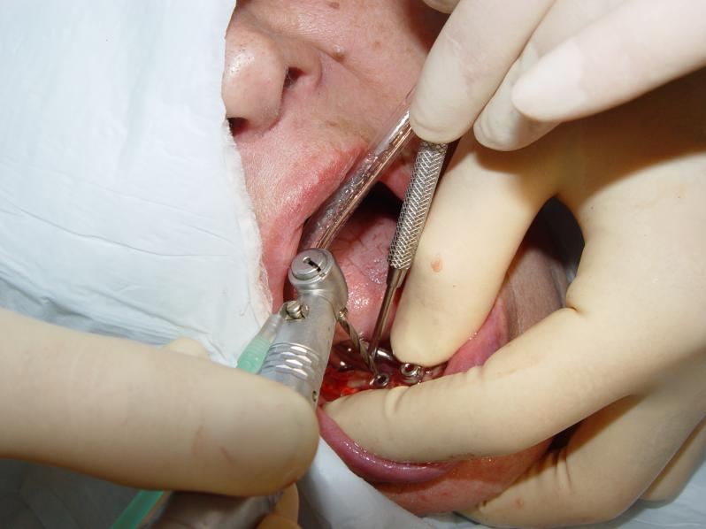 Препарирование челюсти под имплантант
